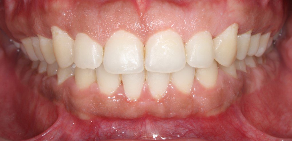 After treatment