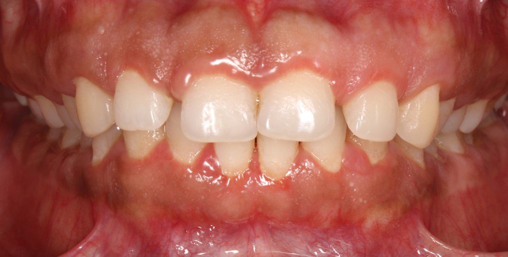 Before treatment