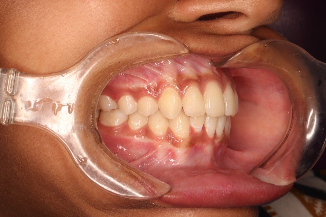 Dixita After